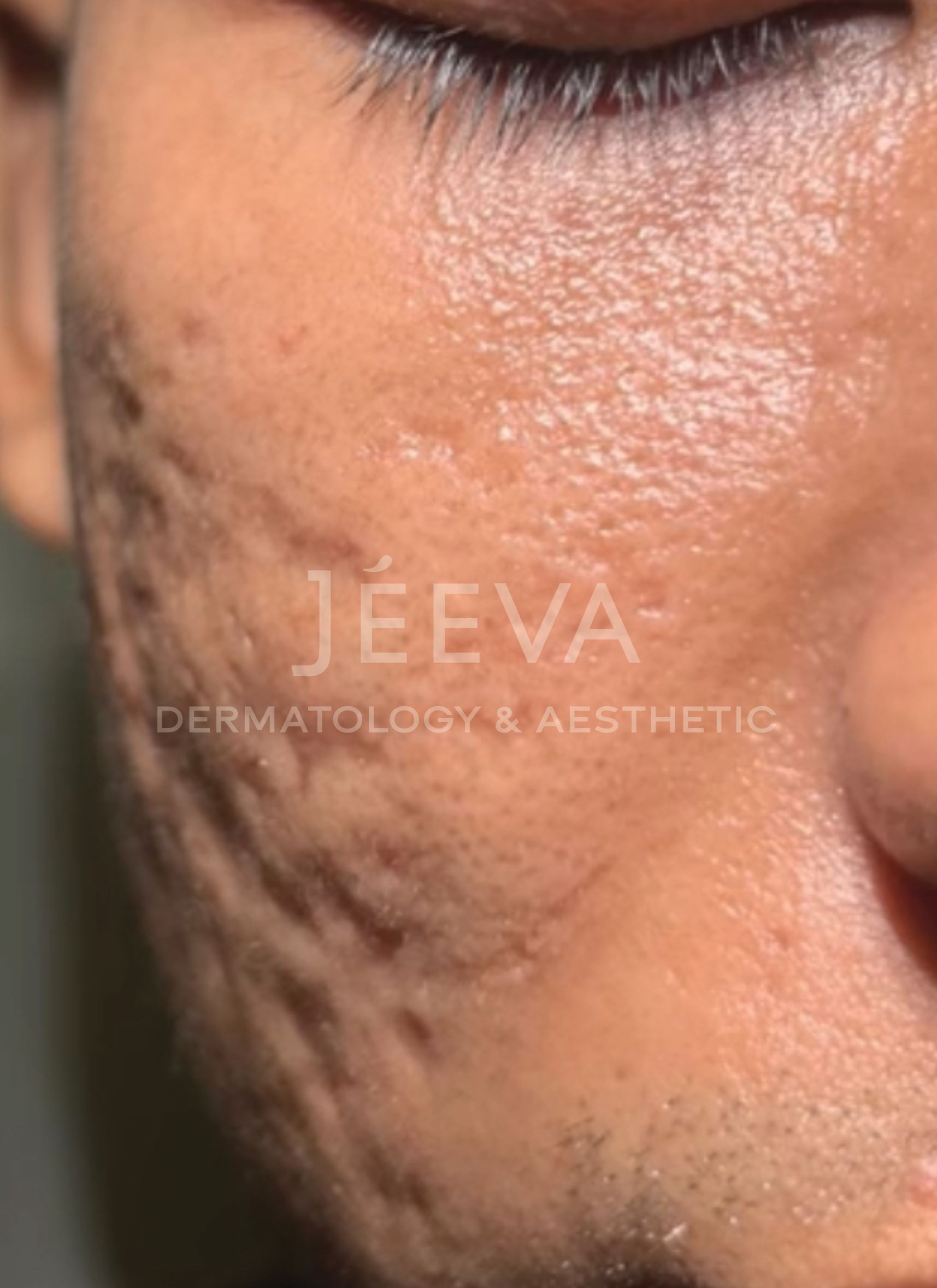 Scar / Bopeng - before