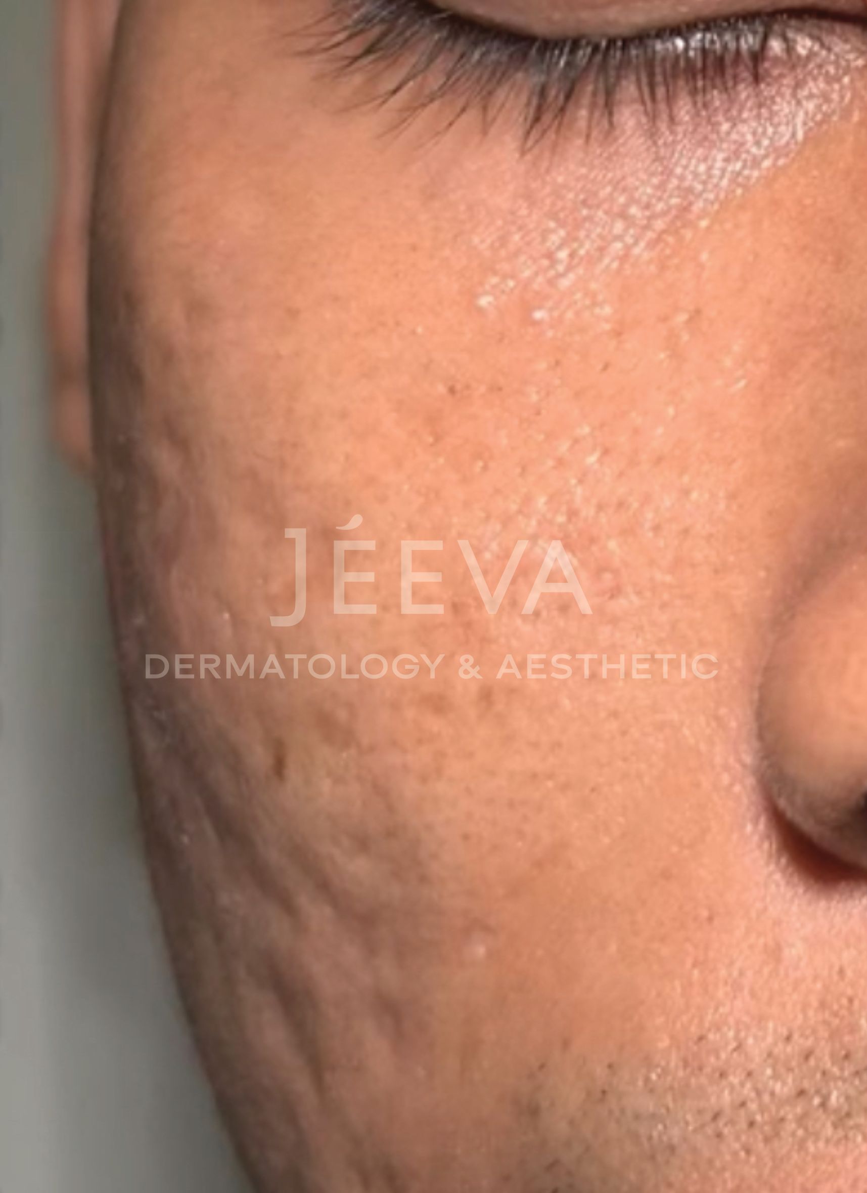 Scar / Bopeng - after